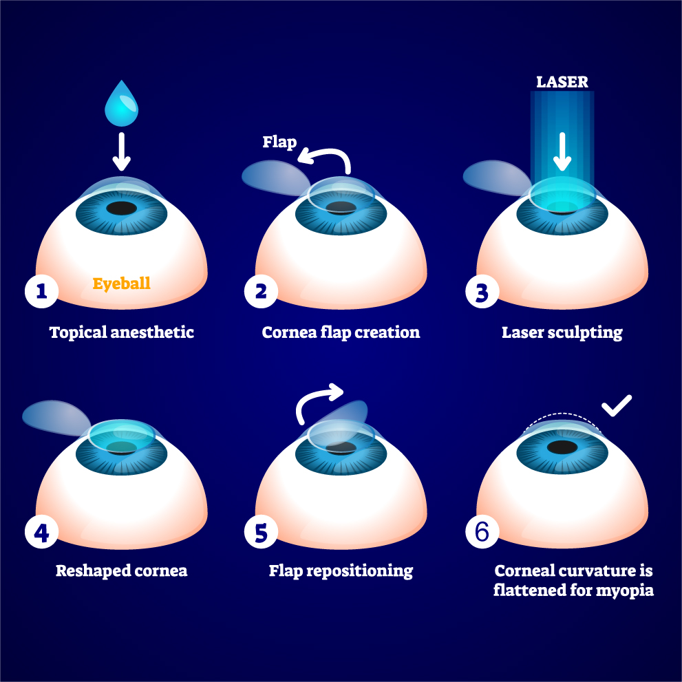 lasik procedure